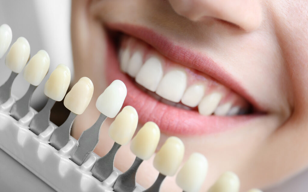 Tooth whitening 